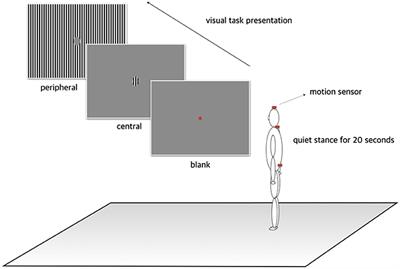 Postural Instability Induced by Visual Motion Stimuli in Patients With <mark class="highlighted">Vestibular Migraine</mark>